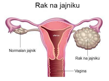 8.maj - Svetski dan borbe protiv raka jajnika